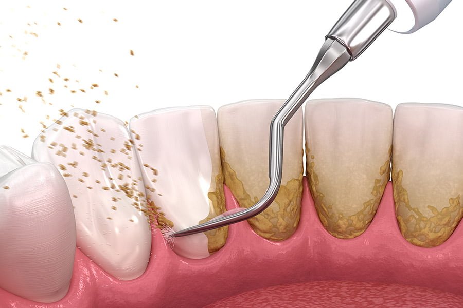 Teeth Cleaning Process